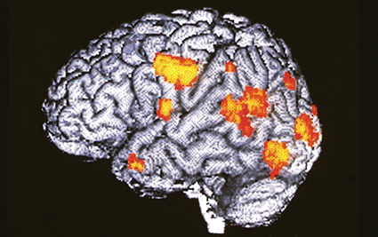 Imagen: Examen cerebral de tomografía de emisión de positrones (TEP) de un paciente masculino esquizofrénico durante una alucinación (Foto cortesía del Dept. de Neurología Cognitiva Wellcome).